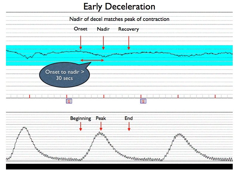 How To Read A Contraction Chart