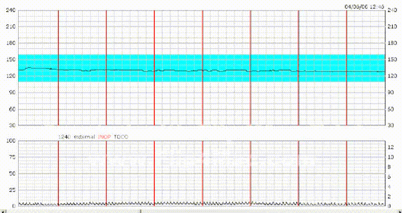 Fetal Tracing Index – Electronic Fetal Monitoring